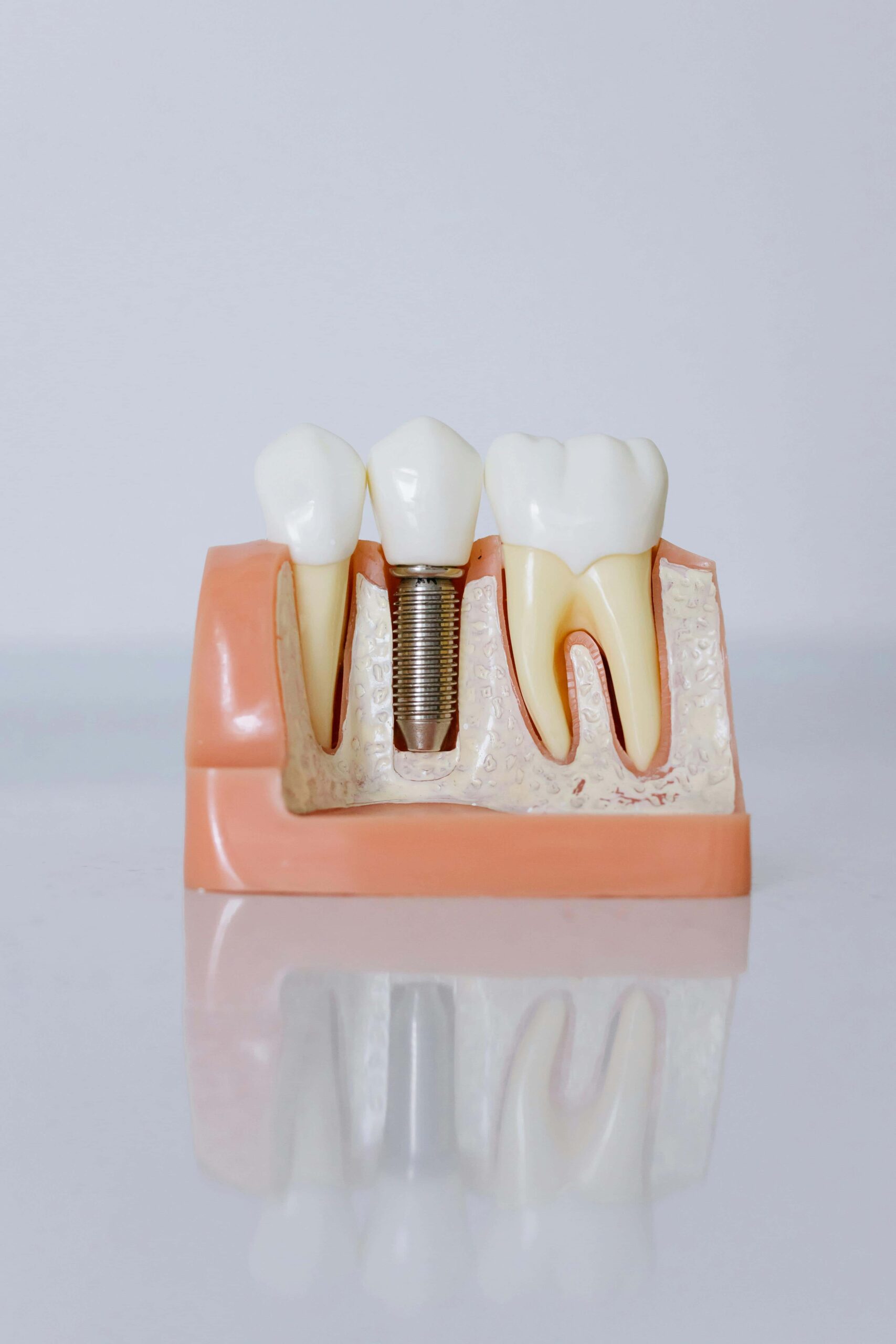 crown on tooth